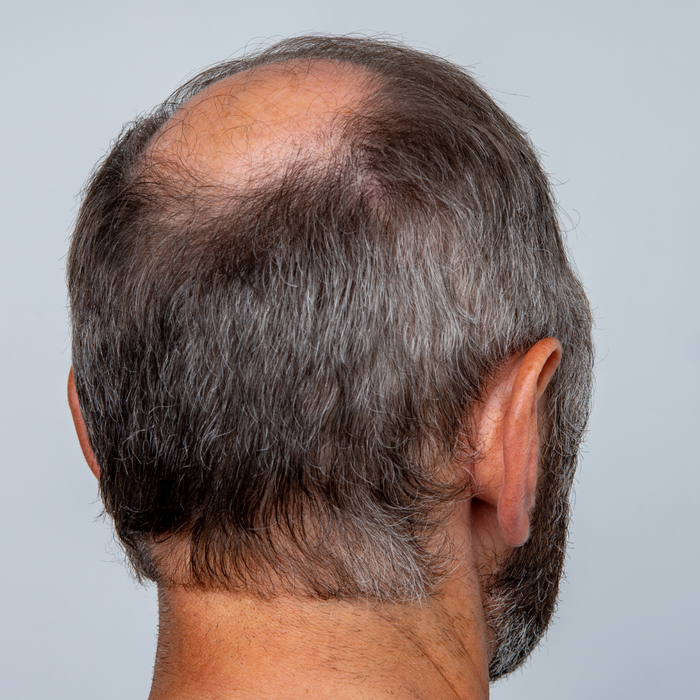 Male Hair Loss: Unveiling the Complex Interplay of Hormones, Genetics, and Emotion